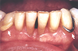 acetal