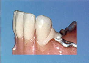 acetal