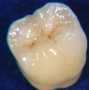COURONNE-EMAX